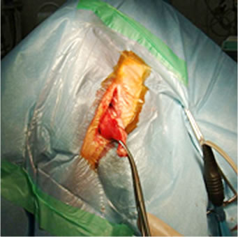 会陰ヘルニア整復術 術中写真