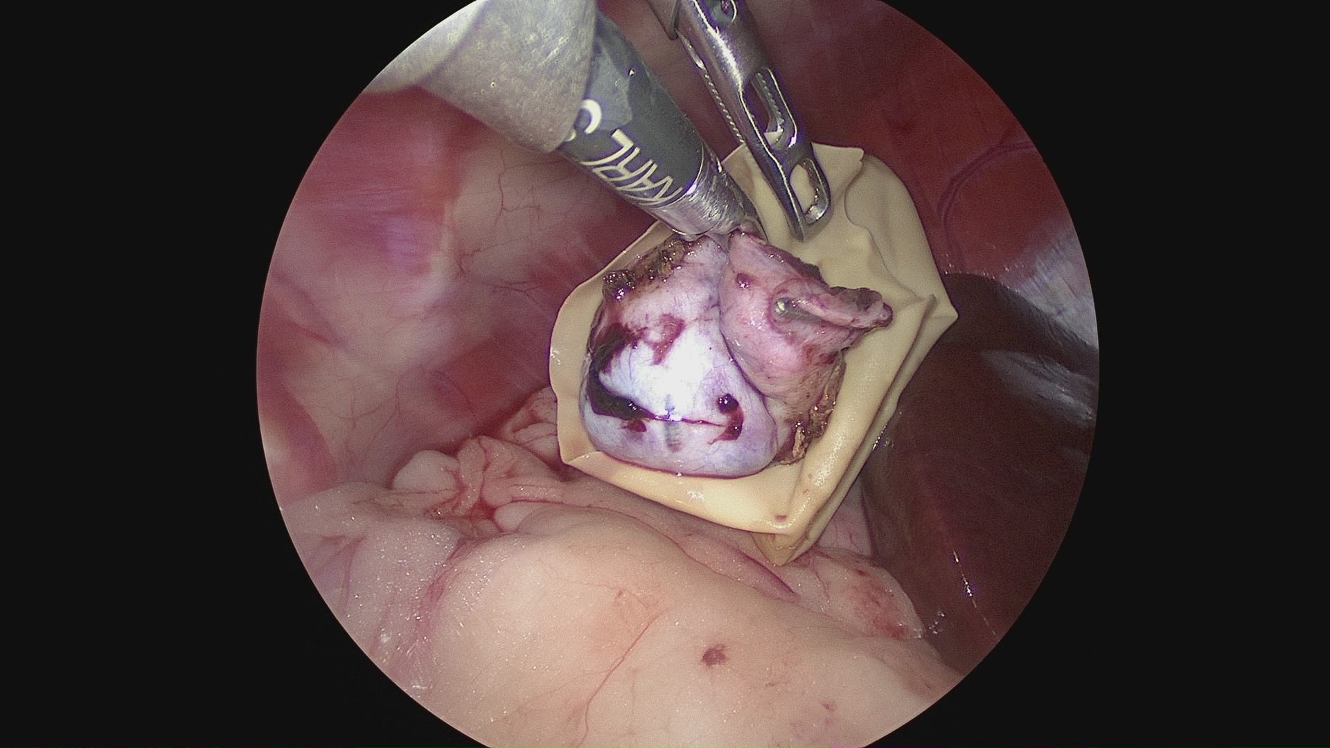腹腔鏡下胆嚢摘出術(術中)