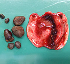 摘出した胆嚢と胆石